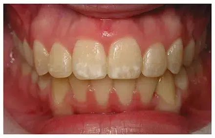 brace1-webp-900×300- (1)
